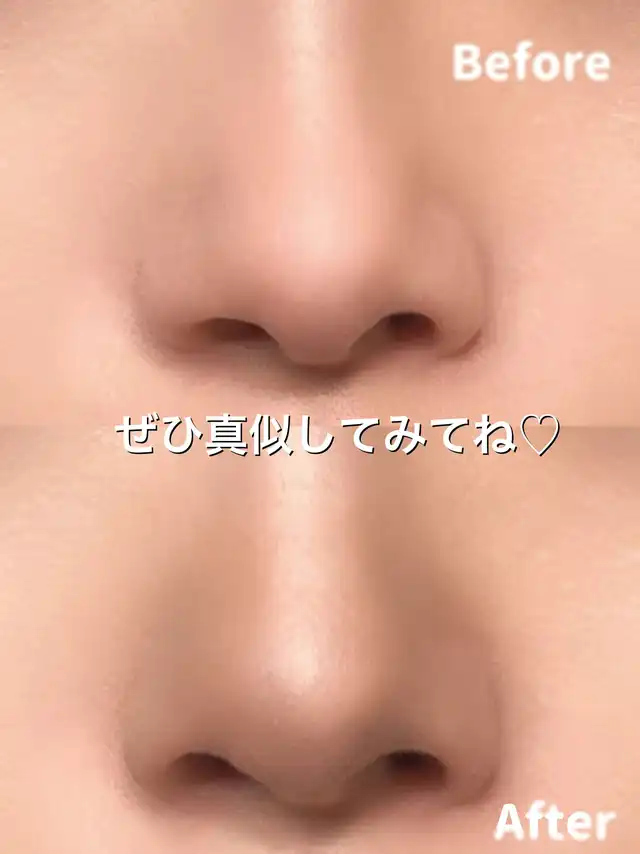 【小鼻整形級!!】嫌な団子鼻とはサヨナラ今日から簡単！小鼻縮小術！！